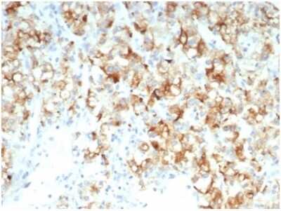 Immunohistochemistry-Paraffin: Cdc20 Antibody (CDC20/7026R) - Azide and BSA Free [NBP3-14078] - Formalin-fixed, paraffin-embedded human kidney carcinomastained with Cdc20 antibody (CDC20/7026R) at 2ug/ml. HIER: Tris/EDTA, pH9.0, 45min. HRP-polymer, 30min. DAB, 5min.