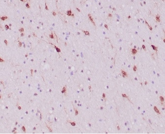 FFPE human glioblastoma with IDH1-R132H mutation stained with Isocitrate Dehydrogenase 1/IDH1 antibody (IDH1/6806R). HIER: Tris/EDTA, pH9.0, 45min. Secondary: HRP-polymer, 30min. DAB, 5min.
