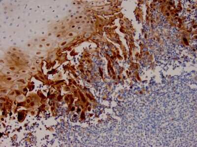 Immunohistochemistry-Paraffin: Herpes Simplex Virus 1 Antibody (HSV1/4055R) - Azide and BSA Free [NBP3-14103] - Formalin-fixed, paraffin-embedded human Esophageal Carcinoma stained with Herpes Simplex Virus 1 antibody (HSV1/4055R).
