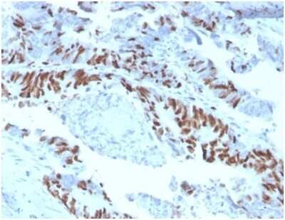 Immunohistochemistry-Paraffin: MCM2 Antibody (MCM2/3678) - Azide and BSA Free [NBP3-14118] - Formalin-fixed, paraffin-embedded human colon carcinoma stained with MCM2 antibody (MCM2/3678).