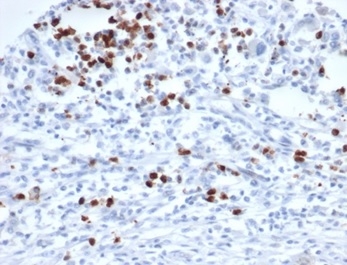 Formalin-fixed, paraffin-embedded human rhabdomyosarcoma stained with MEF2D antibody (PCRP-MEF2D-3A4). HIER: Tris/EDTA, pH9.0, 45min. Secondary: HRP-polymer, 30min. DAB, 5min.