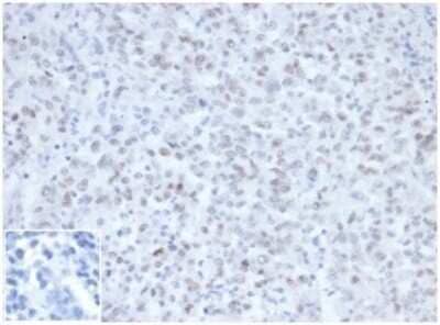 Immunohistochemistry-Paraffin: MLH1 Antibody (MLH1/6467) - Azide and BSA Free [NBP3-14122] - IHC analysis of FFPE Lynch Syndrome / Hereditary Non-Polyposis Colorectal Cancer (HNPCC). MLH1 antibody (MLH1/6467)at 2ug/ml in PBS, 30 min RT. HIER: Tris/EDTA, pH9.0, 45min. HRP-polymer, 30min. DAB, 5min.Inset: PBS instead of primary, secondary control.