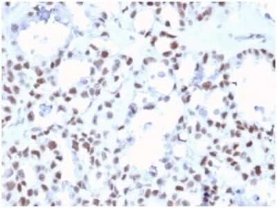 Immunohistochemistry-Paraffin: MLH1 Antibody (MLH1/6467) - Azide and BSA Free [NBP3-14122] - Formalin-fixed, paraffin-embedded human ovarian carcinoma stained with MLH1 antibody (MLH1/6467).