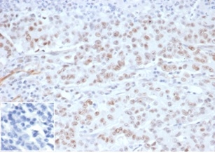 FFPE Lynch Syndrome / Hereditary Non-Polyposis Colorectal Cancer (HNPCC). MLH1 antibody (MLH1/6284R). Inset: PBS instead of primary antibody; secondary only negative control.