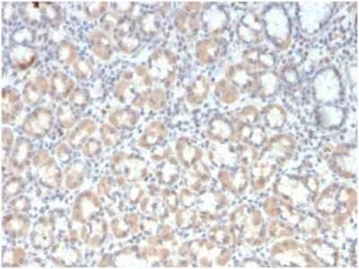 Immunohistochemistry-Paraffin: MUC3 Antibody (rMUC3/1154) - Azide and BSA Free [NBP3-14126] - Formalin-fixed, paraffin-embedded human gastric carcinoma stained with MUC3 antibody (rMUC3/1154). HIER: Tris/EDTA, pH9.0, 45min. HRP-polymer, 30min. DAB, 5min.
