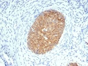 FFPE analysis of human cervical squamous cell carcinoma stained with Serpin B5/Maspin Antibody (SERPINB5/4975) - Azide and BSA Free. HIER: Tris/EDTA, pH9.0, 45min. 2°C: HRP-polymer, 30min. DAB, 5min.