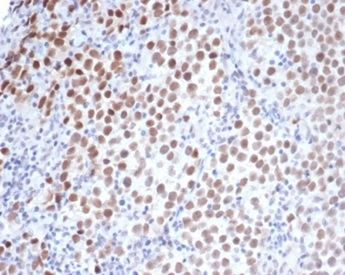 Formalin-fixed, paraffin-embedded human seminoma stained with OCT4 antibody (OCT4/3508) at 2ug/ml. HIER: Tris/EDTA, pH9.0, 45min. Secondary: HRP-polymer, 30min. DAB, 5min.