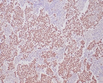 Formalin-fixed, paraffin-embedded human seminoma stained with OCT4 antibody (OCT4/6875R) at 2ug/ml. HIER: Tris/EDTA, pH9.0, 45min. Secondary: HRP-polymer, 30min. DAB, 5min.