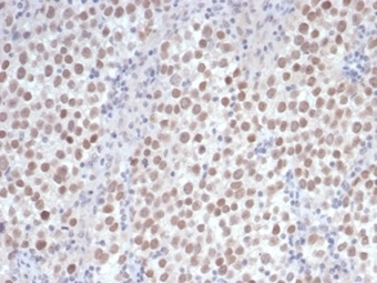 Formalin-fixed, paraffin-embedded human seminoma stained with OCT4 antibody (OCT4/6875R) at 2ug/ml. HIER: Tris/EDTA, pH9.0, 45min. Secondary: HRP-polymer, 30min. DAB, 5min.