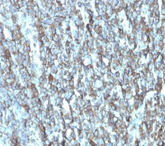 Formalin-fixed, paraffin-embedded human breast carcinoma stained with Migfilin Antibody (FBLIM1/4600) - Azide and BSA Free at 2ug/ml. HIER: Tris/EDTA, pH9.0, 45min. 2°C: HRP-polymer, 30min. DAB, 5min.