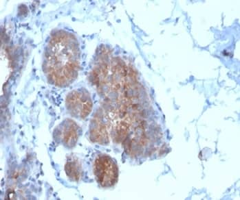 Formalin-fixed, paraffin-embedded human breast carcinoma stained with Migfilin Antibody (FBLIM1/4600) - Azide and BSA Free at 2ug/ml. HIER: Tris/EDTA, pH9.0, 45min. 2°C: HRP-polymer, 30min. DAB, 5min.