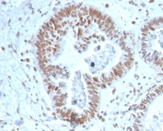 Formalin-fixed, paraffin-embedded human prostate carcinoma stained with ZNF704 antibody (PCRP-ZNF704-3C10). HIER: Tris/EDTA, pH9.0, 45min. Secondary: HRP-polymer, 30min. DAB, 5min.