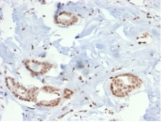 Formalin-fixed, paraffin-embedded human breast carcinoma stained with SOX4 antibody (PCRP-SOX4-1D6). HIER: Tris/EDTA, pH9.0, 45min. Secondary: HRP-polymer, 30min. DAB, 5min.