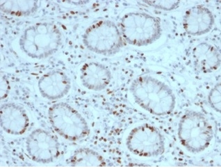 Formalin-fixed, paraffin-embedded human colon carcinoma stained with SOX4 antibody (PCRP-SOX4-1D6). HIER: Tris/EDTA, pH9.0, 45min. Secondary: HRP-polymer, 30min. DAB, 5min.