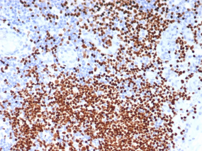 Formalin-fixed, paraffin-embedded human lymph node stained with SOX11 antibody (SOX11/7236). HIER: Tris/EDTA, pH9.0, 45min. Secondary: HRP-polymer, 30min. DAB, 5min.
