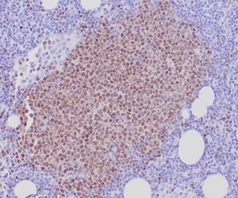 Formalin-fixed, paraffin-embedded human mantle cell lymphoma stained with SOX11 antibody (SOX11/7236). HIER: Tris/EDTA, pH9.0, 45min. Secondary: HRP-polymer, 30min. DAB, 5min.