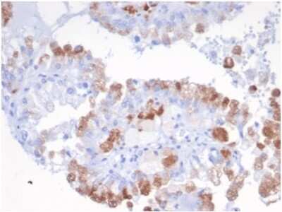 Immunohistochemistry-Paraffin: SREBP2 Antibody (SREBP2/1580) - Azide and BSA Free [NBP3-14186] - IHC analysis of formalin-fixed, paraffin-embedded human Renal carcinoma. Stained using SREBP2 antibody (SREBP2/1580) at 2ug/ml in PBS for 30min RT. HIER: Tris/EDTA, pH9.0, 45min. HRP-polymer, 30min. DAB, 5min.