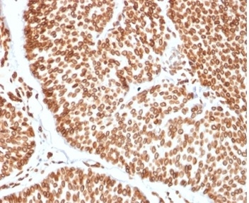 Formalin-fixed, paraffin-embedded human bladder carcinoma stained with TCF4 antibody (TCF4/2252) at 2ug/ml. HIER: Tris/EDTA, pH9.0, 45min. Secondary: HRP-polymer, 30min. DAB, 5min.