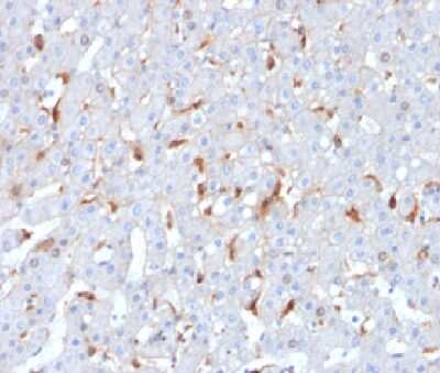 Immunohistochemistry-Paraffin: C1QB Antibody (C1QB/2962) - Azide and BSA Free [NBP3-14195] - Formalin-fixed, paraffin-embedded human hepatocellular carcinoma stained with C1QB antibody (C1QB/2962).