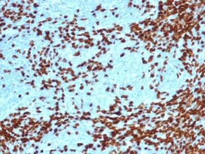 Immunohistochemistry-Paraffin: TdT Antibody (DNTT/4617R) - Azide and BSA Free [NBP3-14201] - Formalin-fixed, paraffin-embedded human thymoma stained with TdT antibody (DNTT/4617R).