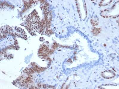 Immunohistochemistry-Paraffin: ERG Antibody (rERG/6843) - Azide and BSA Free [NBP3-14204] - Formalin-fixed, paraffin-embedded human prostate tissue stained with ERG antibody (rERG/6843) at 2ug/ml. HIER: Tris/EDTA pH 9; 95C/45min. Ab: HRP-Polymer:30mins; DAB: 5min.