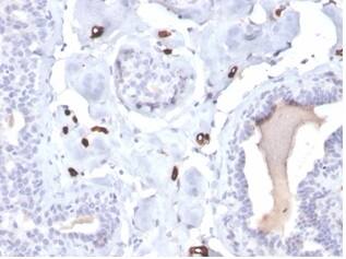 Formalin-fixed, paraffin-embedded human breast carcinoma stained with FABP4/A-FABP Antibody (FABP4/4422) - Azide and BSA Free.
