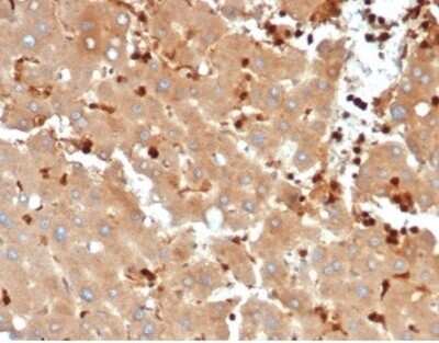 Immunohistochemistry-Paraffin: FABP5/E-FABP Antibody (FABP5/6353R) - Azide and BSA Free [NBP3-14216] - Formalin-fixed, paraffin-embedded human liver metastasized to colon stained with FABP5/E-FABP antibody (FABP5/6353R).