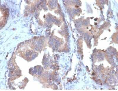 Immunohistochemistry-Paraffin: FABP5/E-FABP Antibody (FABP5/6353R) - Azide and BSA Free [NBP3-14216] - Formalin-fixed, paraffin-embedded human prostate carcinoma stained with FABP5/E-FABP antibody (FABP5/6353R).