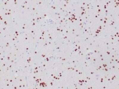Immunohistochemistry-Paraffin: Olig2 Antibody (OLIG2/6695R) - Azide and BSA Free [NBP3-14217] - Formalin-fixed, paraffin-embedded human oligodendroglioma stained with Olig2 antibody (OLIG2/6695R).