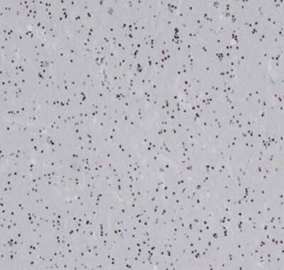 Immunohistochemistry-Paraffin: Olig2 Antibody (OLIG2/6695R) - Azide and BSA Free [NBP3-14217] - Formalin-fixed, paraffin-embedded human glioma stained withOlig2 antibody (OLIG2/6695R).