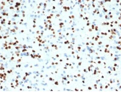 Immunohistochemistry-Paraffin: Olig2 Antibody (OLIG2/7074R) - Azide and BSA Free [NBP3-14218] - Formalin-fixed, paraffin-embedded human brain stained with Olig2 antibody (OLIG2/7074R).