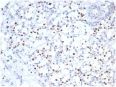 Immunohistochemistry-Paraffin: p57 Kip2 Antibody (KIP2/7083R) - Azide and BSA Free [NBP3-14222] - IHC analysis of formalin-fixed, paraffin-embedded human kidney cancer. Strong nuclear staining using p57 Kip2 antibody (KIP2/7083R)at 2ug/ml in PBS for 30min RT. HIER: Tris/EDTA, pH9.0, 45min. HRP-polymer, 30min. DAB, 5min.