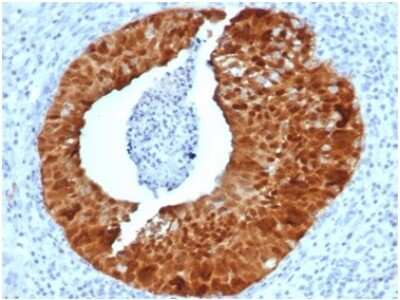 Immunohistochemistry-Paraffin: p16INK4a/CDKN2A Antibody (CDKN2A/4844R) - Azide and BSA Free [NBP3-14223] - Formalin-fixed, paraffin-embedded human cervix stained with p16INK4a/CDKN2A antibody (CDKN2A/4844R).