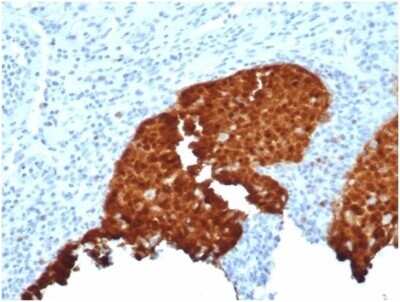 Immunohistochemistry-Paraffin: p16INK4a/CDKN2A Antibody (CDKN2A/4844R) - Azide and BSA Free [NBP3-14223] - Formalin-fixed, paraffin-embedded human cervix stained with p16INK4a/CDKN2A antibody (CDKN2A/4844R).