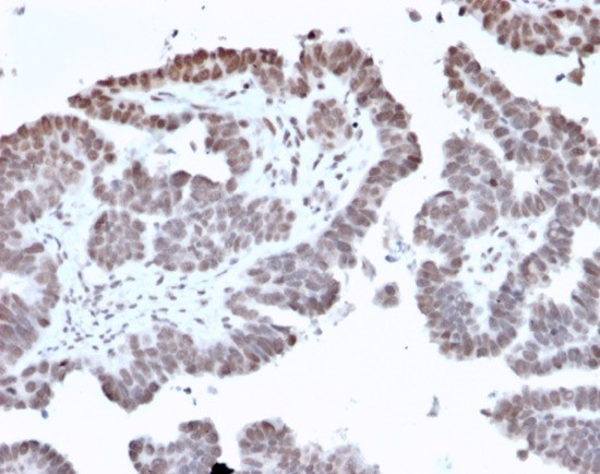 Formalin-fixed, paraffin-embedded human prostate stained. FOXI1 antibody (PCRP-FOXL1-1F8) at 2ug/ml. HIER: Tris/EDTA, pH9.0, 45min. Secondary: HRP-polymer, 30min. DAB, 5min.