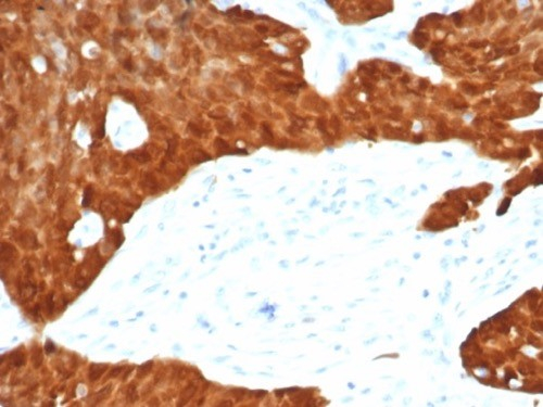 Formalin-fixed, paraffin-embedded human ovarian carcinoma stained with p16INK4a/CDKN2A antibody (CDKN2A/7081R).