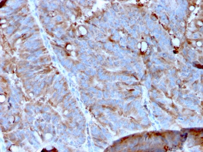 Formalin-fixed, paraffin-embedded human Colon Carcinoma stained with Mer Antibody (MERTK/3023) - Azide and BSA Free.