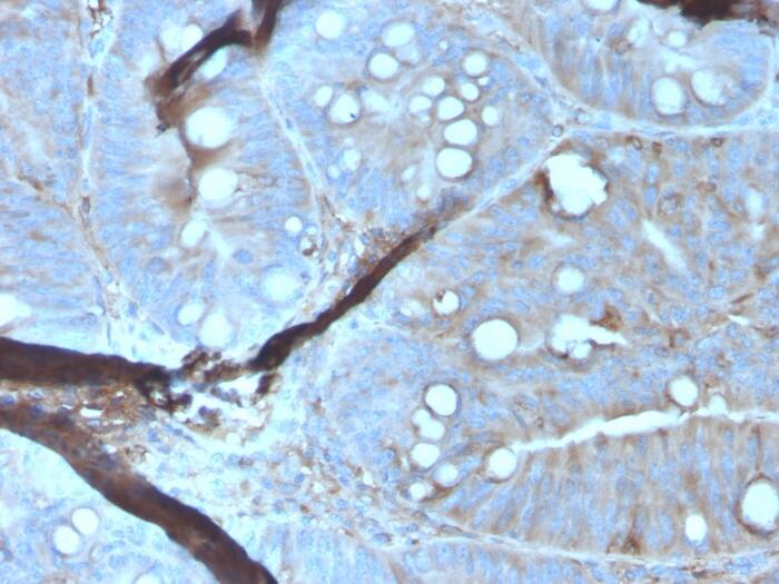 Formalin-fixed, paraffin-embedded human Colon Carcinoma stained with Mer Antibody (MERTK/3023) - Azide and BSA Free.