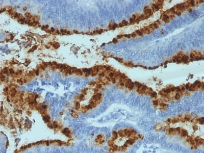 Immunohistochemistry-Paraffin: Fucosyltransferase 3/FUT3 Antibody (2-25LE; same as LWB01) - Azide and BSA Free [NBP3-14260] - Formalin-fixed, paraffin-embedded human Colon Carcinoma stained with Fucosyltransferase 3/FUT3 antibody (2-25LE; same as LWB01).