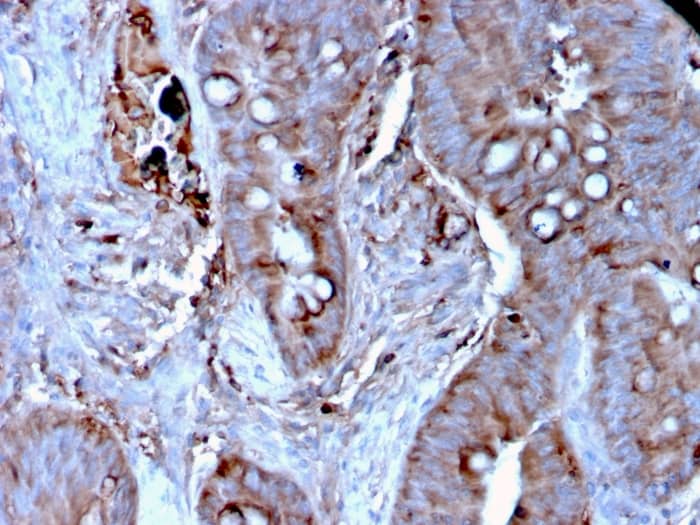 Formalin-fixed, paraffin-embedded human Colon Carcinoma stained with Mer Antibody (MERTK/3024) - Azide and BSA Free.