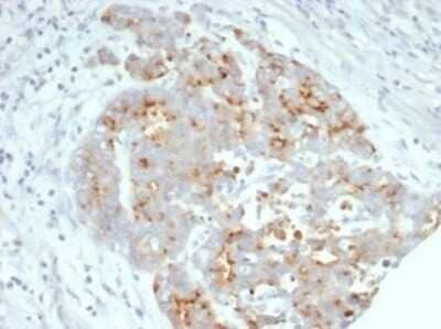 Immunohistochemistry-Paraffin: CFTR Antibody (CFTR/7003R) - Azide and BSA Free [NBP3-14272] - Formalin-fixed, paraffin-embedded human ovarian carcinoma stained with CFTR antibody (CFTR/7003R). Inset: PBS instead of primary antibody; secondary only negative control.