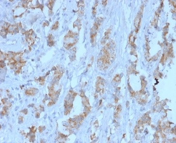Formalin-fixed, paraffin-embedded human ovarian carcinoma stained. TDRKH antibody (PCRP-TDRKH-1H2) at 2ug/ml. HIER: Tris/EDTA, pH9.0, 45min. Secondary: HRP-polymer, 30min. DAB, 5min.