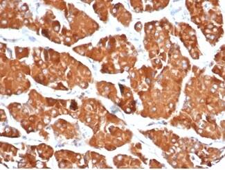 IHC analysis of formalin-fixed, paraffin-embedded human renal oncocytoma. Staining using RHOBTB2 Antibody (DBC2/3361) - Azide and BSA Free at 2ug/ml in PBS for 30min RT. HIER: Tris/EDTA, pH9.0, 45min. 2°C: HRP-polymer, 30min. DAB, 5min.