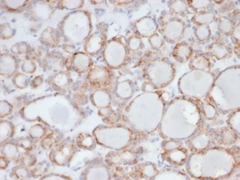Formalin-fixed, paraffin-embedded human thyroid stained with UBR2 antibody (PCRP-UBR2-1D12) at 2ug/ml. HIER: Tris/EDTA, pH9.0, 45min. Secondary: HRP-polymer, 30min. DAB, 5min.