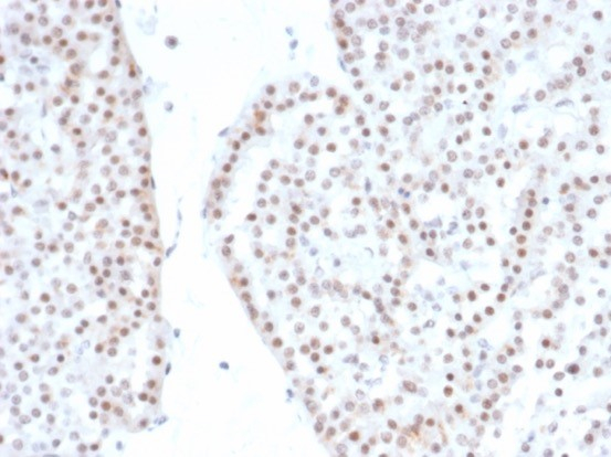 Formalin-fixed, paraffin-embedded human renal oncocytoma stained with SF-1/NR5A1/Steroidogenic Factor 1 antibody (NR5A1/4368R). HIER: Tris/EDTA, pH9.0, 45min. Secondary: HRP-polymer, 30min. DAB, 5min.