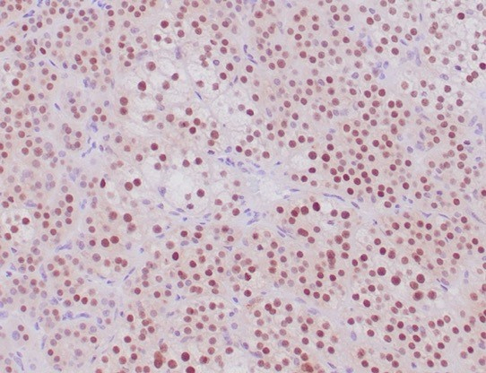 Formalin-fixed, paraffin-embedded human adrenal cortical tumor stained with SF-1/NR5A1/Steroidogenic Factor 1 antibody (NR5A1/4368R). HIER: Tris/EDTA, pH9.0, 45min. Secondary: HRP-polymer, 30min. DAB, 5min.
