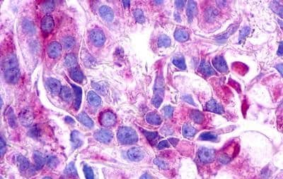 Immunohistochemistry: Galanin R3/GALR3 Antibody [NBP3-14329] - Immunohistochemistry of Lung, adenocarcinoma