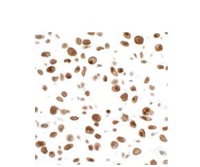  Rabbit anti-STAT3 recombinant monoclonalantibody [BLR098G]. Secondary: HRPconjugated goat anti-rabbit. IgG  Substrate:DAB.