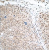  Rabbit anti-STAT3 recombinant monoclonalantibody [BLR098G] Secondary: HRPconjugated goat anti-rabbit IgG. Substrate:DAB.