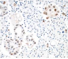  Rabbit anti-STAT3 recombinant monoclonal, Lung cancer, antibody [BLR098G],  Secondary: HRPconjugated goat anti-rabbit IgG. Substrate:DAB.